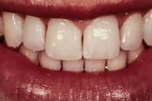 A close up of the teeth with white teeth