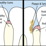Gum Disease | Cosmetic Dentistry Center MA