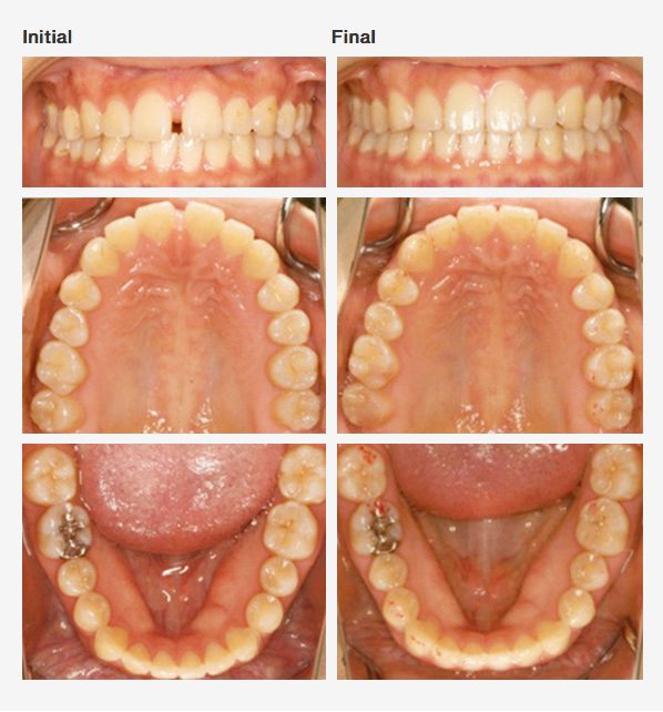 Rapid Orthodontics | Cosmetic Dentistry Center MA