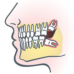 Wisdom Teeth | Cosmetic Dentistry Center MA