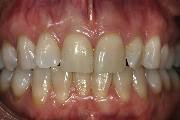 Veneers Before and After Photos Boston MA | Newton MA