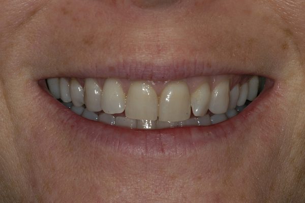 Veneers Before and After Photos Boston MA | Newton MA