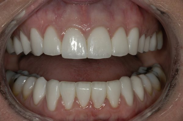 Dental Veneers Before and After Photos Boston MA | Newton MA
