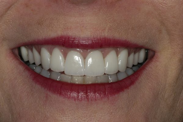 Dental Veneers Before and After Photos Boston MA | Newton MA
