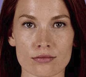 Voluma Before & After photos Boston MA | Newton 