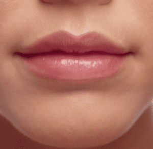Lip Augmentation & After photos Boston MA | Newton